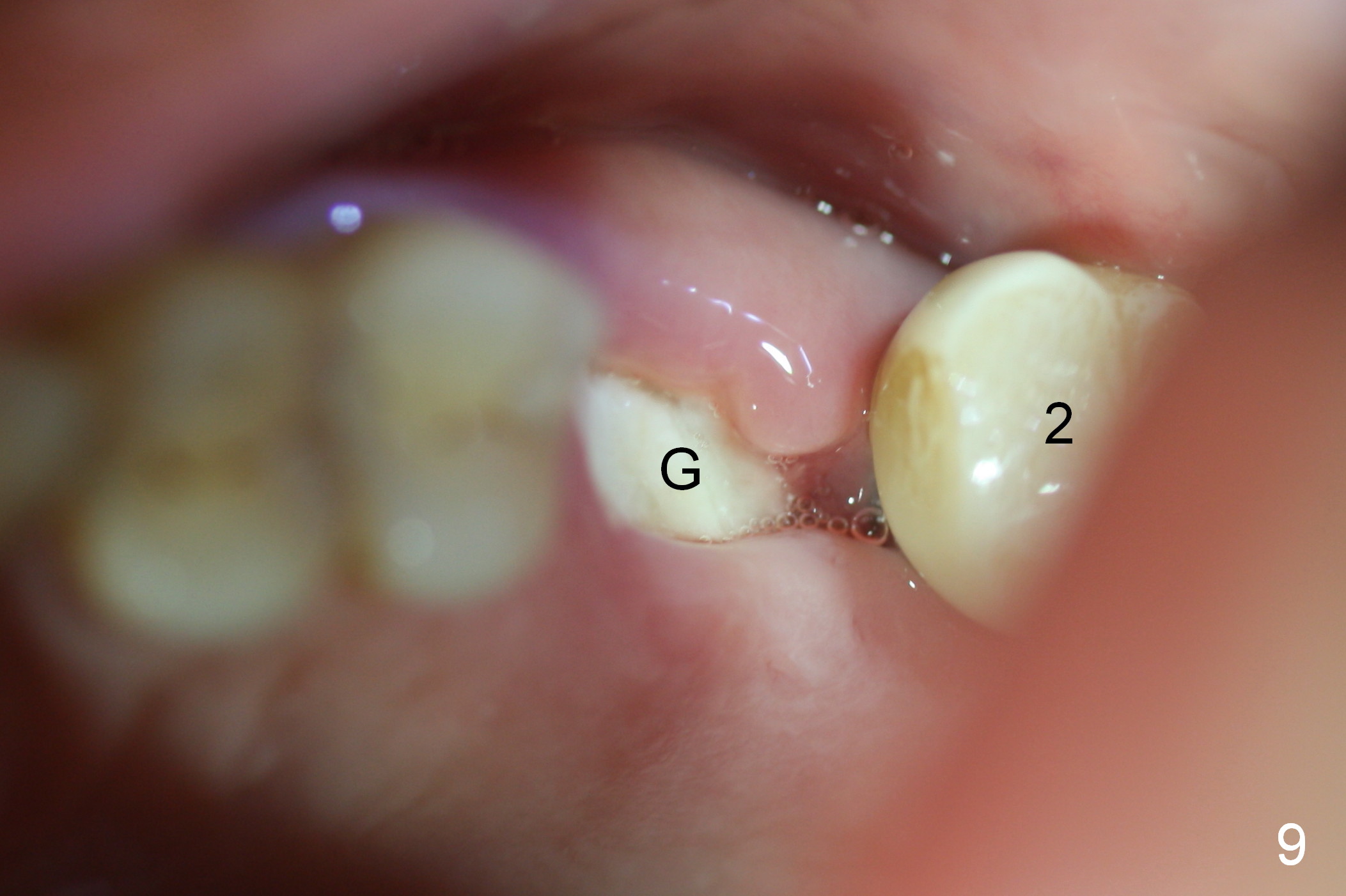 10 Professional How To Put Gauze On Wisdom Teeth Latest